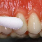 1280px-cold_test_with_ethyl_chloride