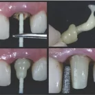 a-testing-of-the-insertion-of-the-glass-fiber-post-b-customized-glass-fiber-post-with_1