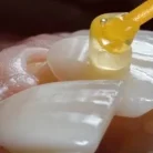 aesthetic-dentistry-porcelain-veneers-cementation-260nw-1496083076_11zon