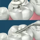 composite_filling1_1_1