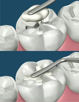 composite_filling1_1_1 composite_filling1_1_1