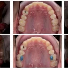 intraoral-photos-a-before-and-b-