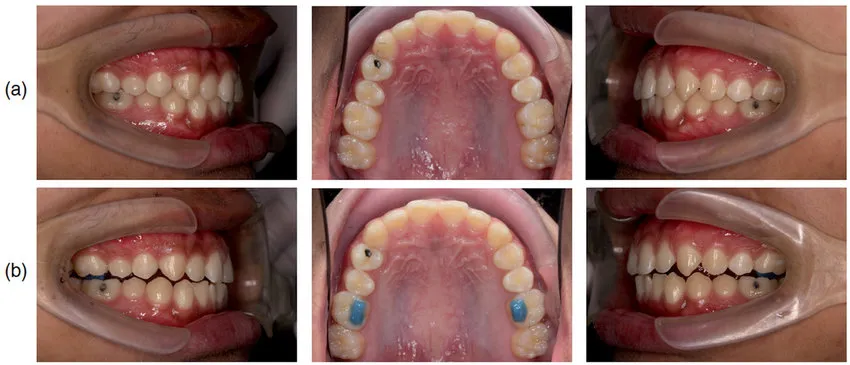 intraoral-photos-a-before-and-b- intraoral-photos-a-before-and-b-