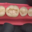 ivoclar-tetric-n-bond-universal-6gm-1000x1000_2__11zon_1_1