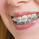 metal-braces-armenia