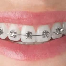 metallic-braces