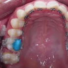 tecnica-levante-de-mordida-en-ortodoncia (1)