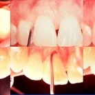 walgracey_curettes_1