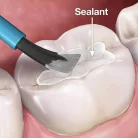 blog-pit-fissure-sealants-featured-image