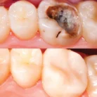 composite-restorations