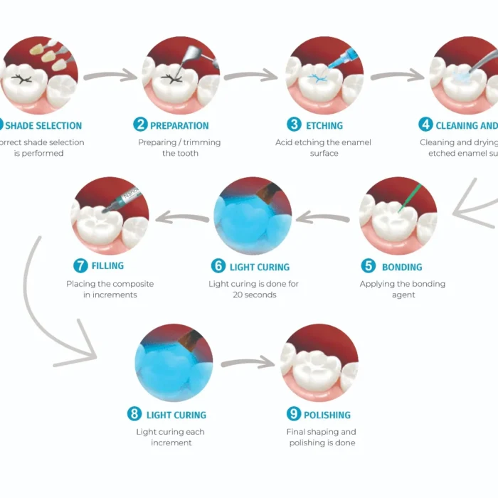 composite_filling_process_1_ composite_filling_process_1_