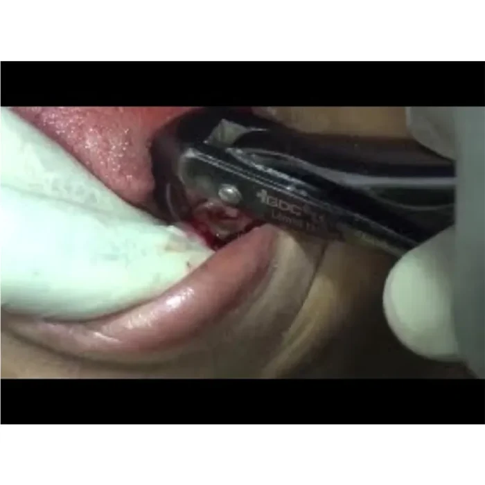 forcep1_1