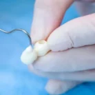 glass-ionomer-cement-luting_11zon