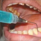 subgingival-application-of-gengigelr